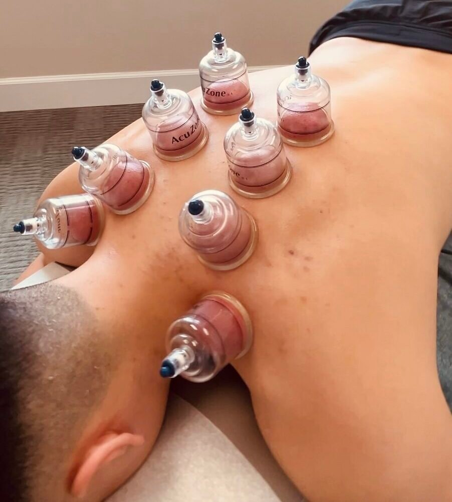 Cupping therapy at Flex Chiropractic in Pearland for pain relief and muscle tension reduction