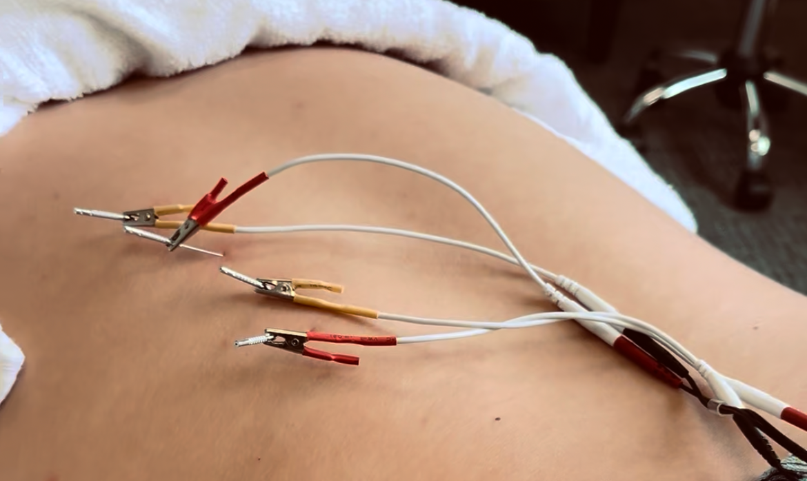 Dry needling treatment being performed by a chiropractor at Flex Chiropractic in Pearland, TX